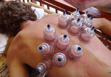 Вакуумный баночный массаж