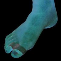 MCK10333000 - Pedifix Toe Spacer Visco-Gel ToeBuddy One Size Fits Most Without Closure Left or Right Foot