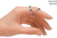 Murphy Ring Splint, Stainless Steel #2