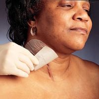 Sammons Preston Mepiform Self-Adherent Silicone Dressing 1-3/5" x 12" (4 x 30 cm))