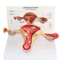 LXX Scientific Human Anatomy - Uterine Lesion Model - Anatomical Science Model of Female Internal and External Organs - Medical Organ Teaching Models -for Medical Trainning Aid