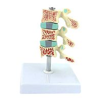 LXX Scientific Human Anatomy - Osteoporosis Model - Intervertebral Disc Human Lumbar Vertebrae Orthopedic Pain Model