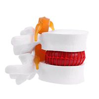 zobeen Human Anatomical Lumbar Disc Herniation Model Learn Aid Anatomy Instrume