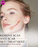 Remove Scar Anti Scar Skin Treatment Repair Remove Scar Cream, Removal Scar Stretch Marks