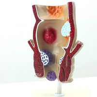 Medical Science Rectum Fissure Lesion Model 1.5X Human Anorectal Pathology Model Hemorrhoid Anal Fistula
