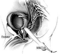 MAVIT for prostate gland vibromassage magnetic therapy PEMF Voltage 220V