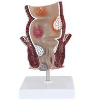 LXX Scientific Human Anatomy - Rectal Pathology Model Magnify 1.5 Times Acne Anorectal Rectal Disease Demonstration