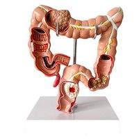 LXX Human Large Intestine Anatomical Model Visceral Lesion Model - Colon Pathology Model PVC Human Anatomical Anatomy Digestive System Studying Teaching Model