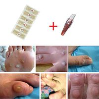 Foot Corn Removal Plaster Chicken Eye Ointment Paste Wart Remover Pads Plantar Wart Treatment Foot Corn Paste Wart Callus Calluses Foot Care Pads Wart Remover Corn Treatment Remover Plantar