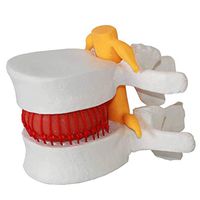 LXX Medical Spine Lumbar Disc Herniation Model Spine Model Skeleton Collectibles Medical Educational Training Aid