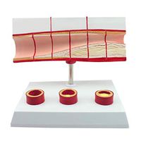 LXX Heart-Vascular Cholesterol Model Thrombosis Process Anatomy Model Coronary Heart Disease Blood Cholesterol Human Heart Medical Teaching Anatomical Model