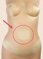 Oleeva 37UM-EA Umbilicoplasty Scar Shape
