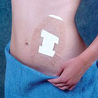 MCK20432000 - Brown Medical Industries Shield Dressing SEAL-TIGHT 8 L X 5 W Inch, 6 L X 3.5 W Inch Coverage Area