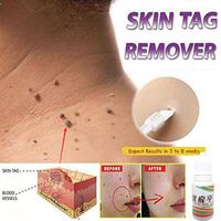 Gonikm Strength Skin Tag Remover Foot Treatment Mole Skin Tag Body Warts Remover Athletes Foot Remedies