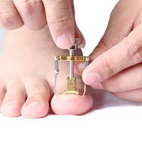 RFJF Professional Ingrown Nail Correction Tool Kit,Acronyx Orthotics Applianc,High-Ranking Stainless Steel Material,Treat of Ingrown Nail，Eliminate Toe Ingrown Pain Professional Tool（5PCS ）