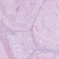 Human Cirrhosis of Liver, sec. 7 m H&E Microscope Slide