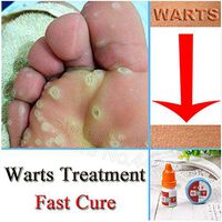 REFIT Chinese Medicine Treatment Foot Corn Removal Cream Plantar Warts Treatment Foot Medical Plaster Ointment Warts Removal Liquid