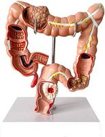 LXX Human Large Intestine Anatomical Model Visceral Lesion Model - Colon Pathology Model PVC Human Anatomical Anatomy Digestive System Studying Teaching Model