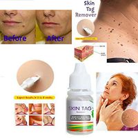 Yiwa Skin Tag Remover Medical Remover Skin Tag Mole & Genital Wart Remover