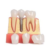 4 Times Dental Implant Teeth Model, Implant Analysis Crown Bridge Demonstration Model