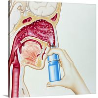 Artwork of Nasal Spray Being Used in hay Fever Canvas Wall Art Print, 20"x20"x1.25"