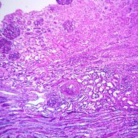 Human Endometriosis of Ovary, sec. 7 m H&E Microscope Slide